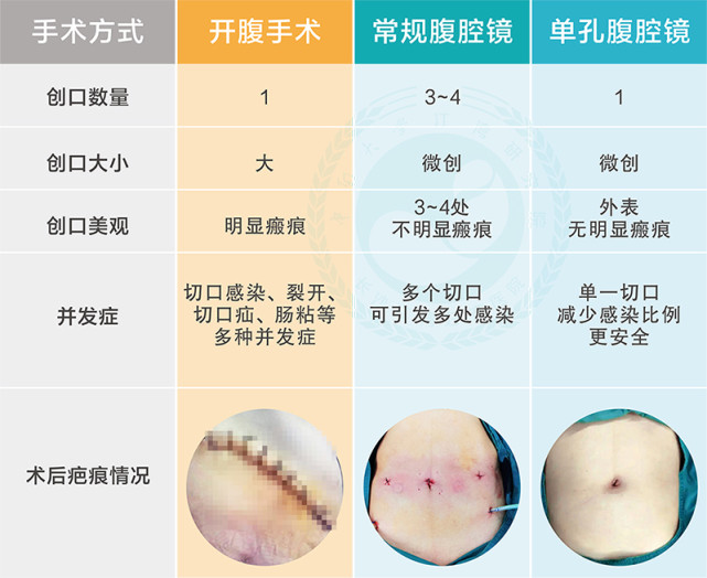 宫外孕、畸胎瘤，3D单孔腹腔镜下微创手术解决患者大难题