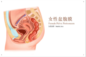 盆腔粘连怎么办？这项技术解开腹中“隐形枷锁”