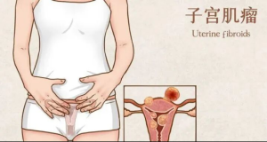 子宫肌瘤怎么办？江湾妇科双镜合璧温柔“拆弹”