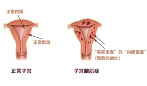 备孕发现子宫腺肌症，一定要做试管吗？