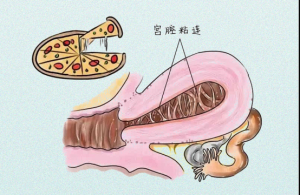 治宫腔粘连：不止要分开，更要守住珍贵的子宫内膜